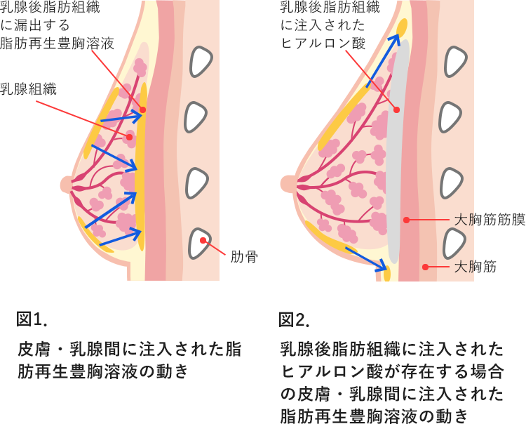 ハイブリッド豊胸 豊胸失敗を成功に変えるために読むサイト