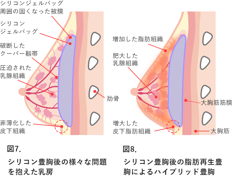 ハイブリッド豊胸 豊胸失敗を成功に変えるために読むサイト