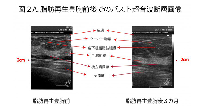 図2A.脂肪再生豊胸前後でのバスト超音波断層画像